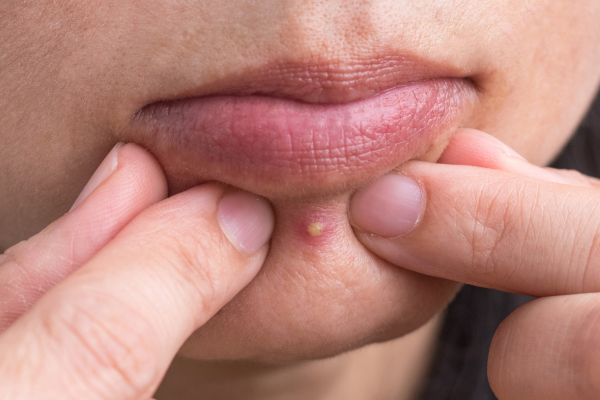 Up close of chin popping pimple