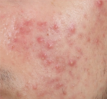 Acne on cheek up close