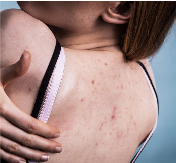 Acne on woman's back