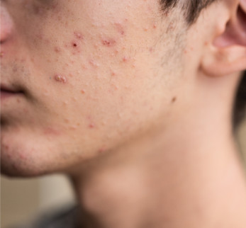 Acne on man's cheek