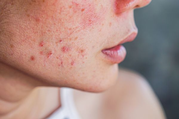 Up close image of woman's cheek with acne