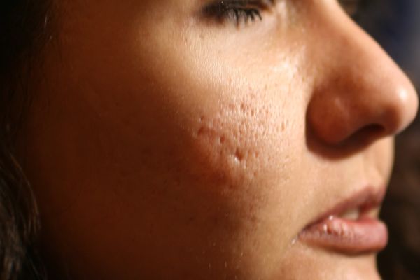 Woman with acne scarring on cheeks