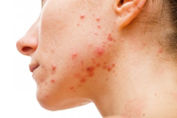 Woman's jawline with acne