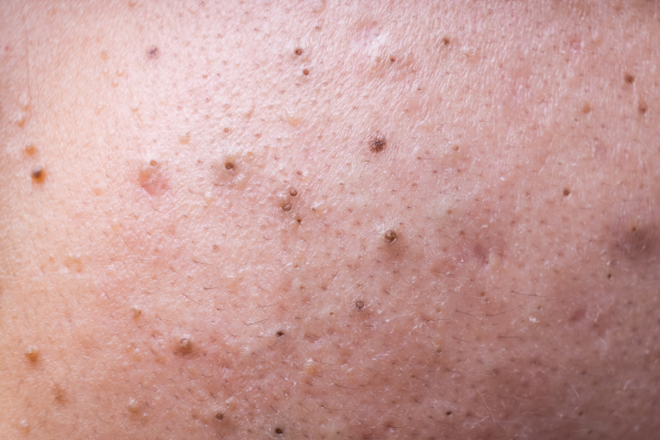 Blackheads up close