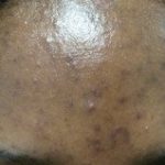 Dark marks on forehead