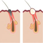 Clogged pore diagram