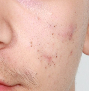 Blackheads on cheek