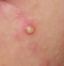 Pustule