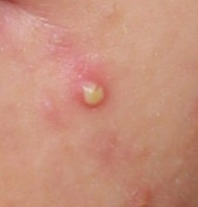 Pimple up close