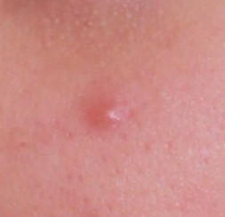 Up close pimple