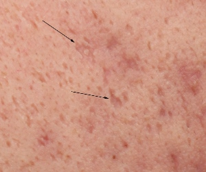 Acne scars up close