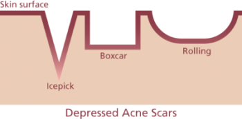 Acne scar diagram