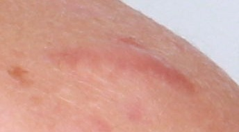 Raised acne scars