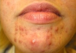 Chin with acne