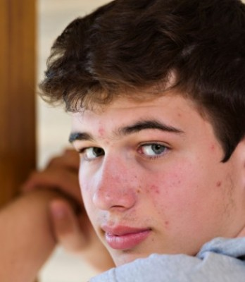 Boy with mild-moderate acne looking over shoulder 