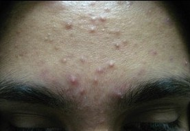 Forehead with moderate acne
