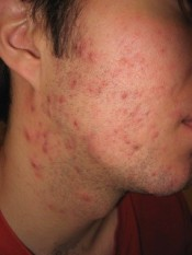 Cheek with moderate acne