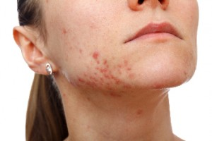 Woman's jawline with moderate acne