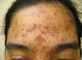 Girl's forehead with severe acne