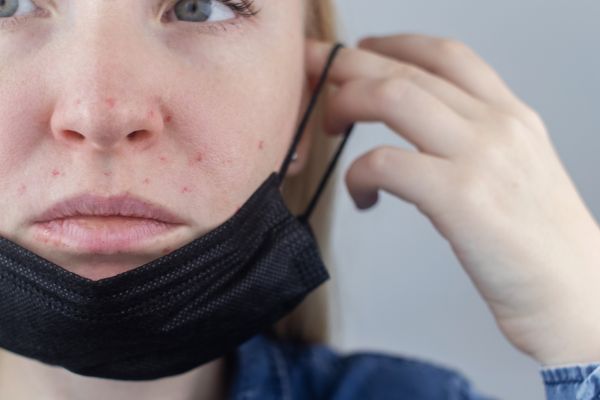 Up close image of woman with acne around mouth and nose putting on a surgical mask