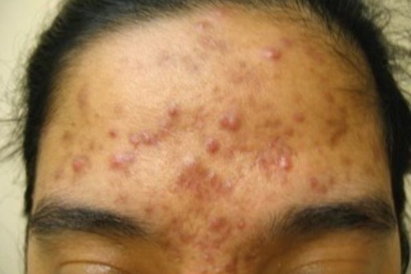 Forehead with severe acne