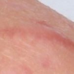 Acne scars up close