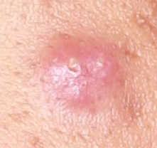 cystic acne up close
