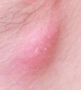 acne nodule up close