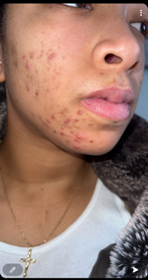 Ottawa teen acne