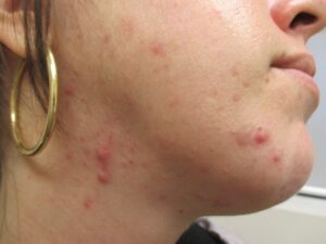 Cystic acne face