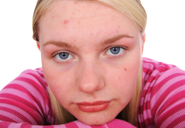 Girl with mild acne on forehead
